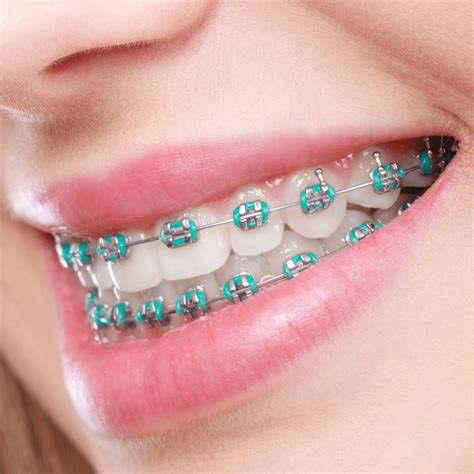 dental ortho metal dental orthodontic brackets|traditional metal braces cost.